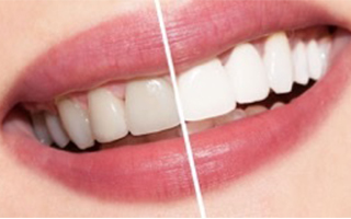 teeth-whitening-320